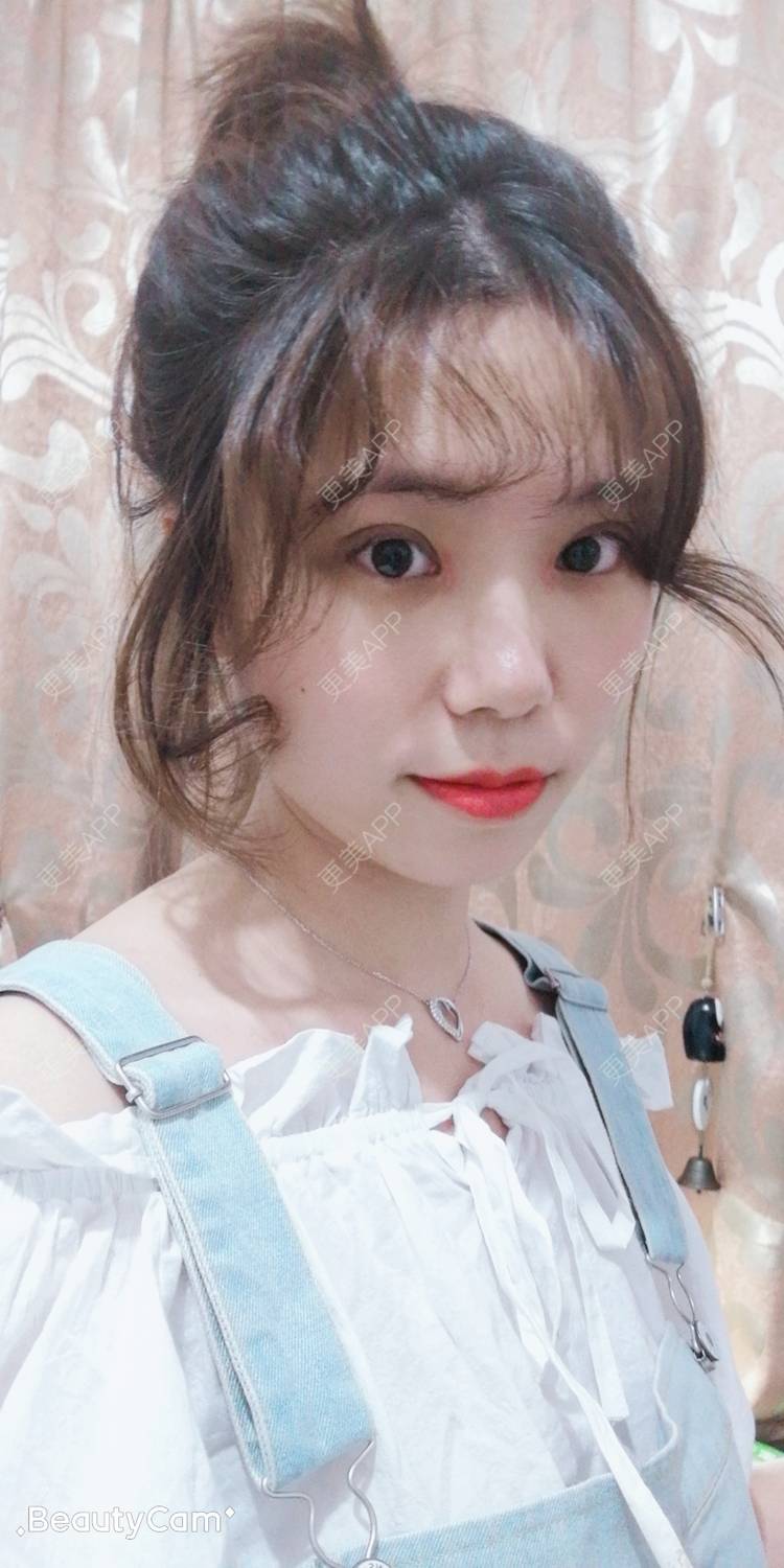 更美 - 墨七轩的双眼皮经验 | 双眼皮 | 全切双眼皮 | 开内眼角 | 开外眼角 | 杭州