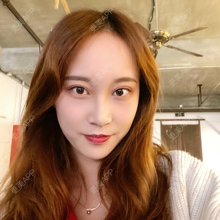 更美 - 半夏0的双眼皮经验 | 双眼皮 | 成都 | 大腿脱毛 | 更美研究所 | 视频日记