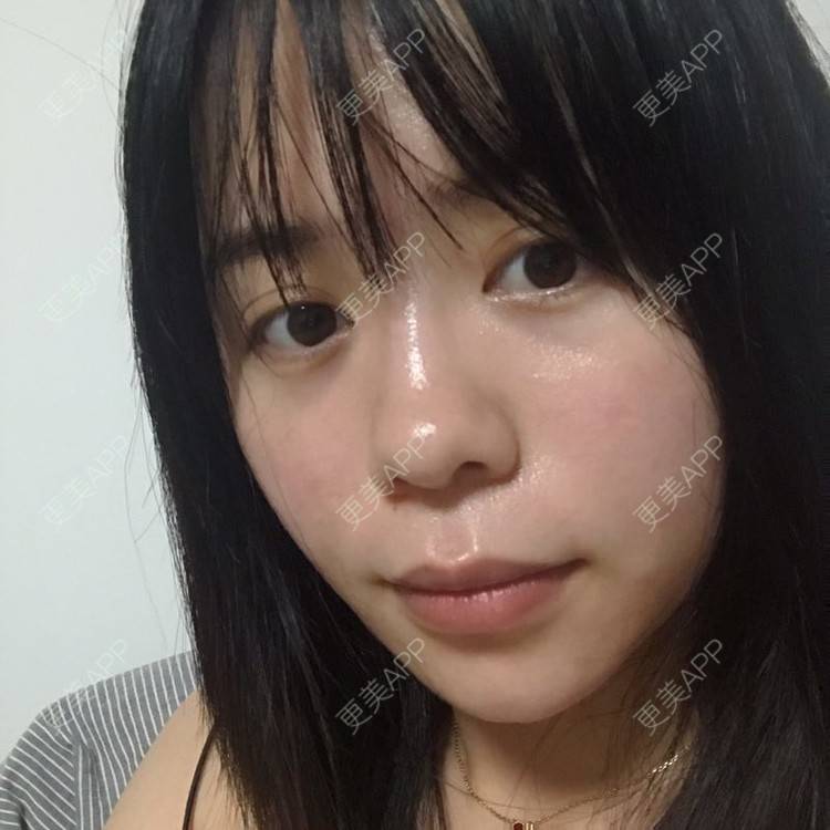 更美 - 更美用户ZxGQi6yGza的除皱套餐经验 | 除皱套餐