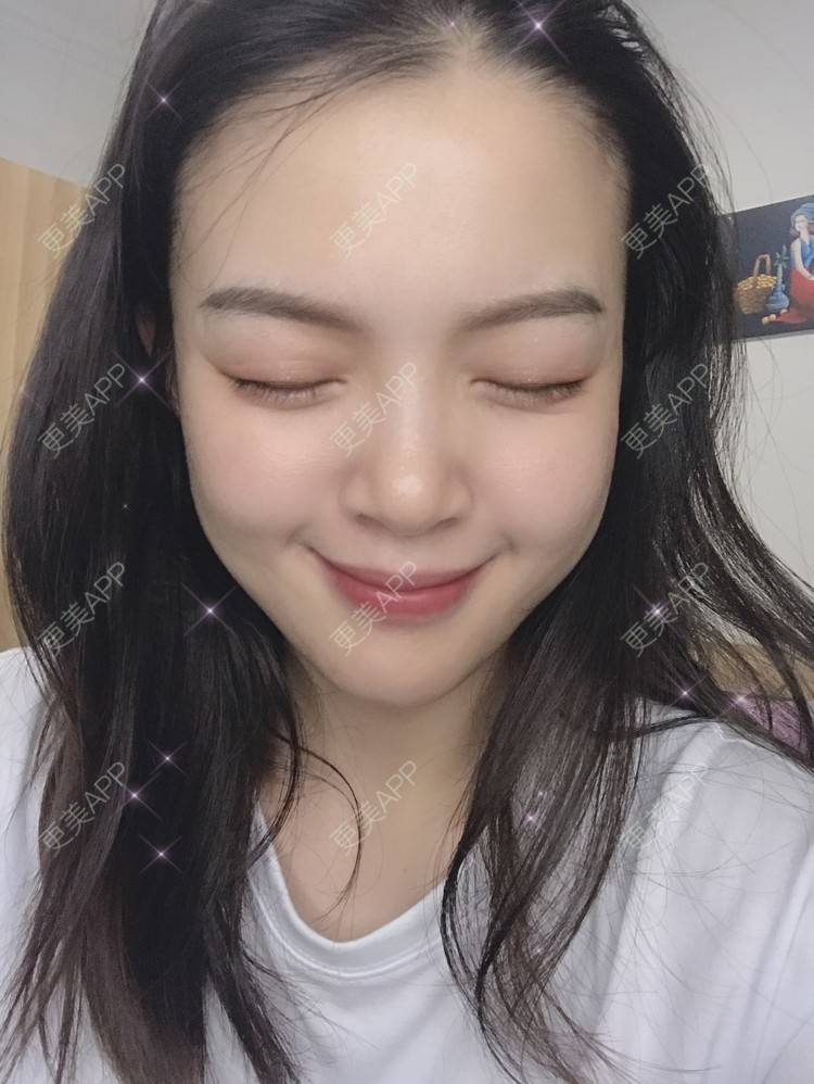 更美 - 更美用户yX5QWTuNiH的双下巴吸脂经验 | 双下巴吸脂 | 重庆