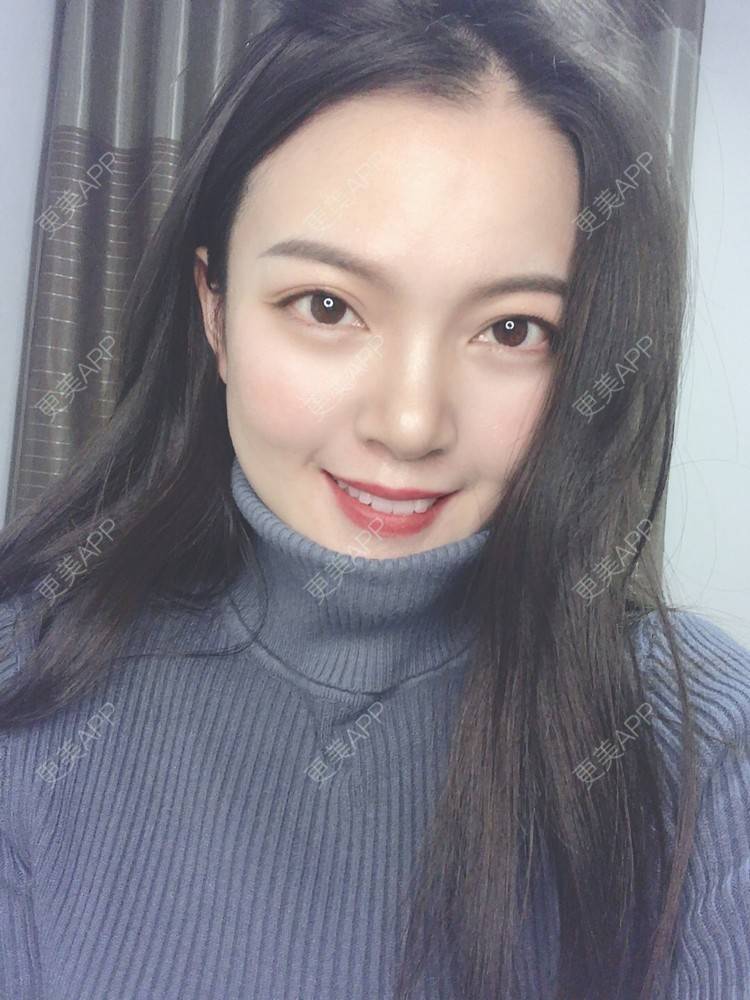 更美 - 更美用户yX5QWTuNiH的双下巴吸脂经验 | 双下巴吸脂 | 重庆
