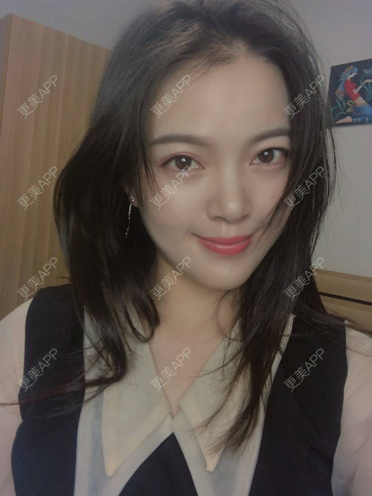 更美 - 更美用户yX5QWTuNiH的双下巴吸脂经验 | 双下巴吸脂 | 重庆