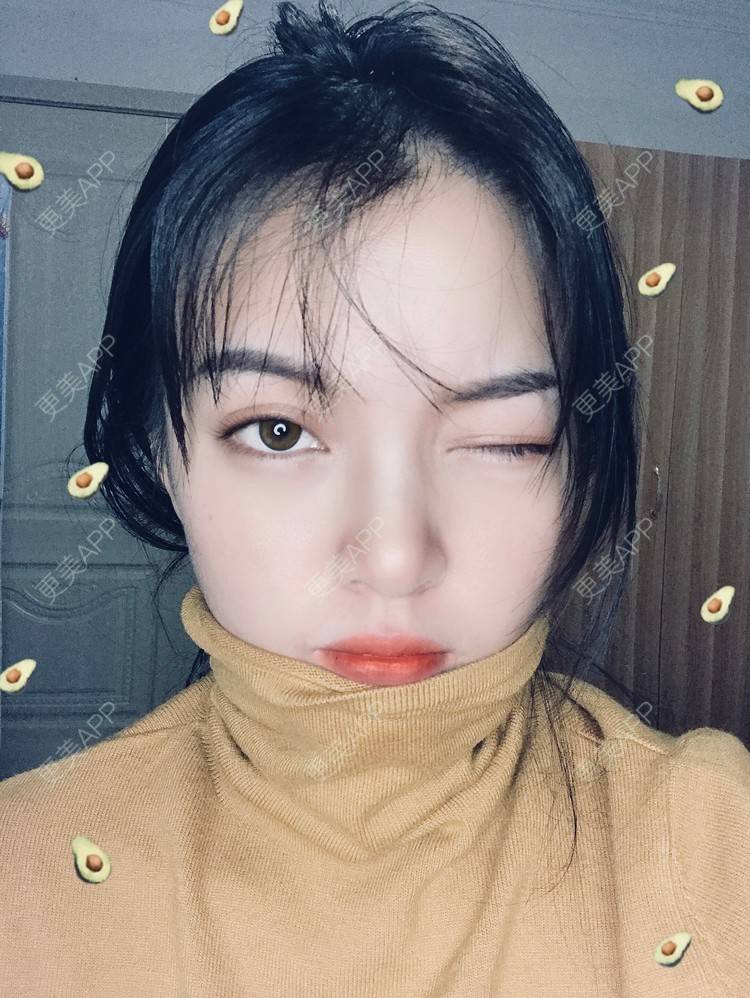 更美 - 更美用户yX5QWTuNiH的双下巴吸脂经验 | 双下巴吸脂 | 重庆