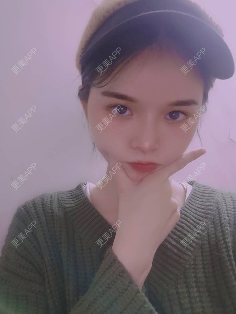 更美 - 莫宁🌸的自体脂肪填充泪沟经验 | 自体脂肪丰额头 | 自体脂肪填充泪沟 | 自体脂肪丰太阳穴 | 自体脂肪丰面颊 | 自体脂肪丰苹果肌 | 自体脂肪垫下巴 | 广州 | 视频日记