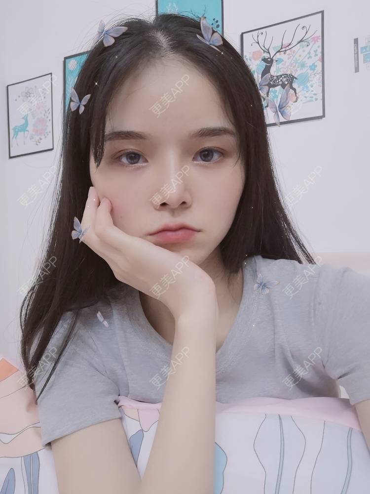 更美 - 莫宁🌸的自体脂肪填充泪沟经验 | 自体脂肪丰额头 | 自体脂肪填充泪沟 | 自体脂肪丰太阳穴 | 自体脂肪丰面颊 | 自体脂肪丰苹果肌 | 自体脂肪垫下巴 | 广州 | 视频日记