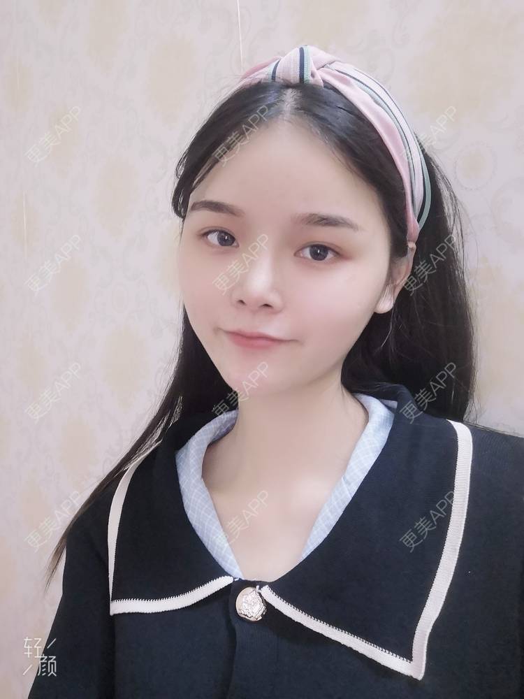 更美 - 莫宁🌸的自体脂肪填充泪沟经验 | 自体脂肪丰额头 | 自体脂肪填充泪沟 | 自体脂肪丰太阳穴 | 自体脂肪丰面颊 | 自体脂肪丰苹果肌 | 自体脂肪垫下巴 | 广州 | 视频日记