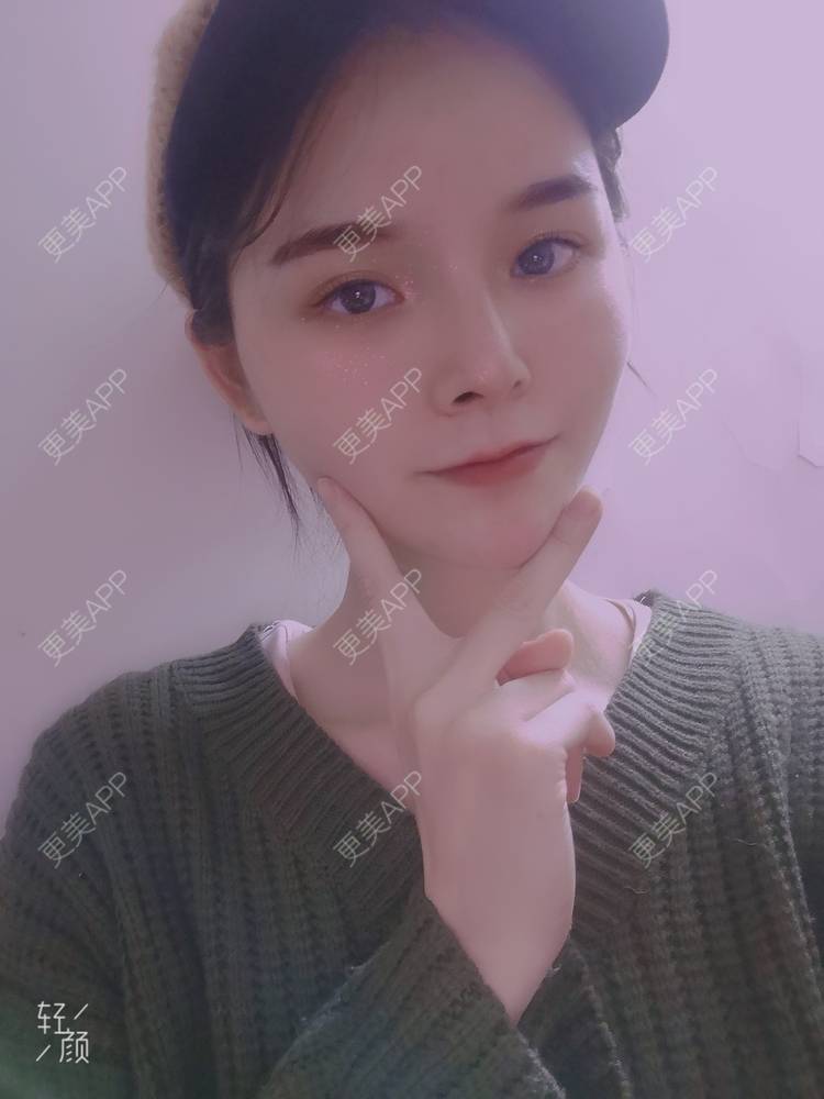 更美 - 莫宁🌸的自体脂肪填充泪沟经验 | 自体脂肪丰额头 | 自体脂肪填充泪沟 | 自体脂肪丰太阳穴 | 自体脂肪丰面颊 | 自体脂肪丰苹果肌 | 自体脂肪垫下巴 | 广州 | 视频日记