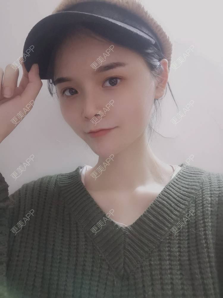 更美 - 莫宁🌸的自体脂肪填充泪沟经验 | 自体脂肪丰额头 | 自体脂肪填充泪沟 | 自体脂肪丰太阳穴 | 自体脂肪丰面颊 | 自体脂肪丰苹果肌 | 自体脂肪垫下巴 | 广州 | 视频日记