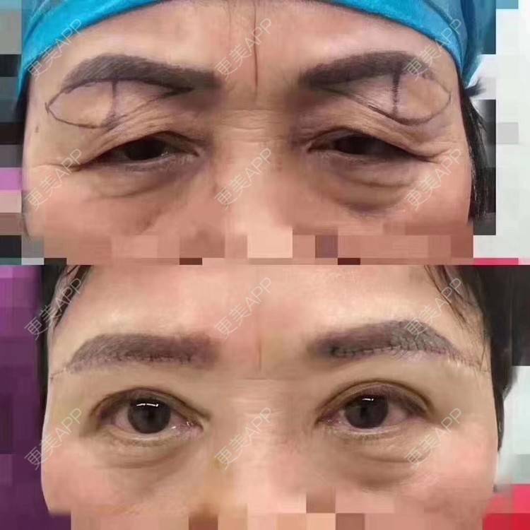 更美 - &千晴医美的外切去眼袋经验 | 外切去眼袋 | 提眉修复 | 杭州