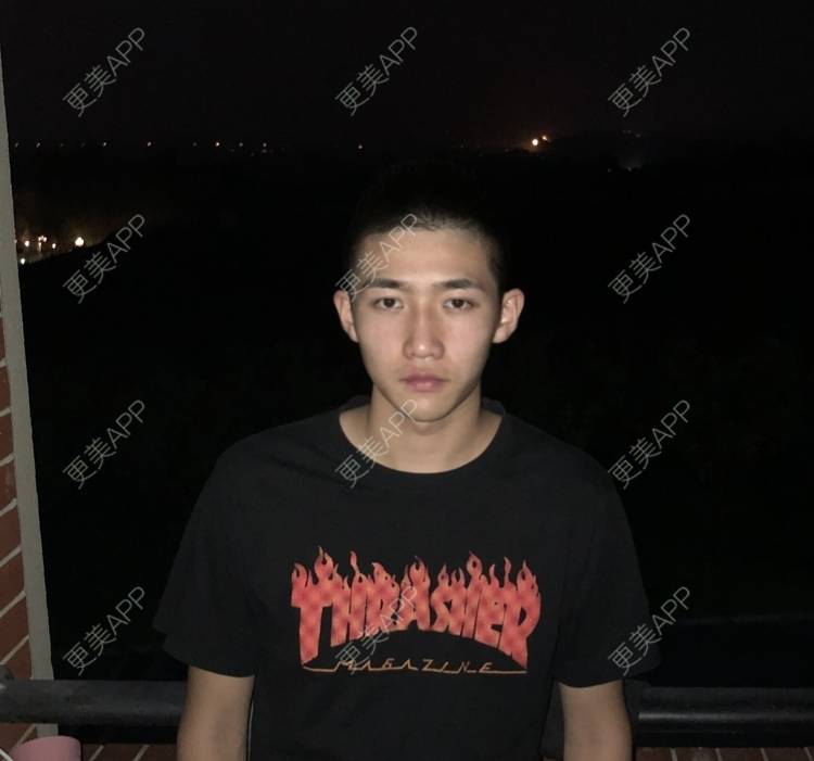 更美 - 仰望ooo的驼峰鼻矫正经验 | 北京 | 视频日记 | 驼峰鼻矫正