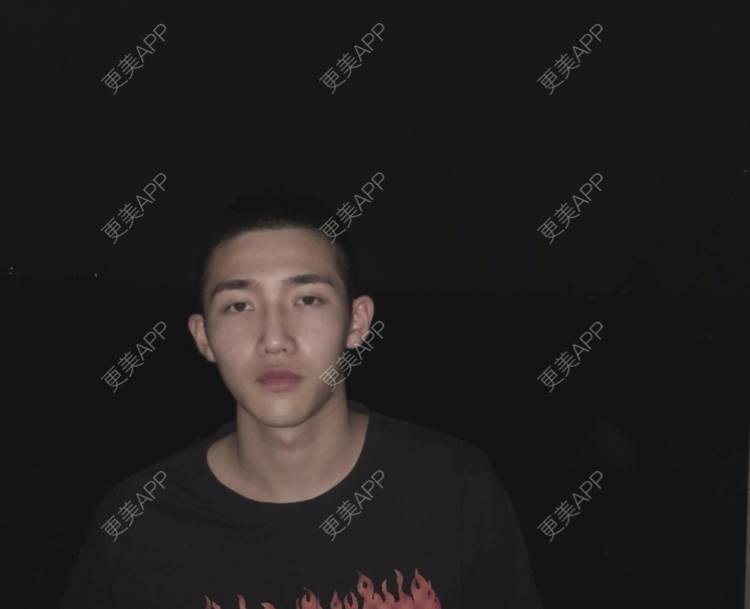 更美 - 仰望ooo的驼峰鼻矫正经验 | 北京 | 视频日记 | 驼峰鼻矫正