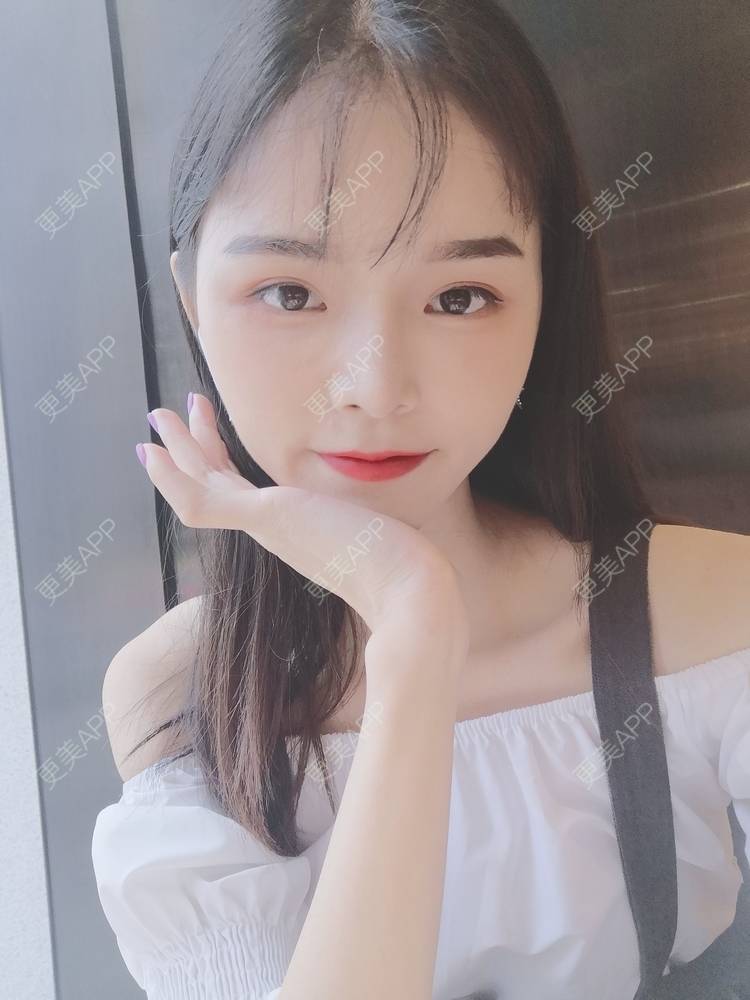 更美 - 莫宁🌸的自体脂肪填充泪沟经验 | 自体脂肪丰额头 | 自体脂肪填充泪沟 | 自体脂肪丰苹果肌 | 自体脂肪丰面颊 | 自体脂肪垫下巴 | 自体脂肪丰太阳穴 | 广州 | 视频日记