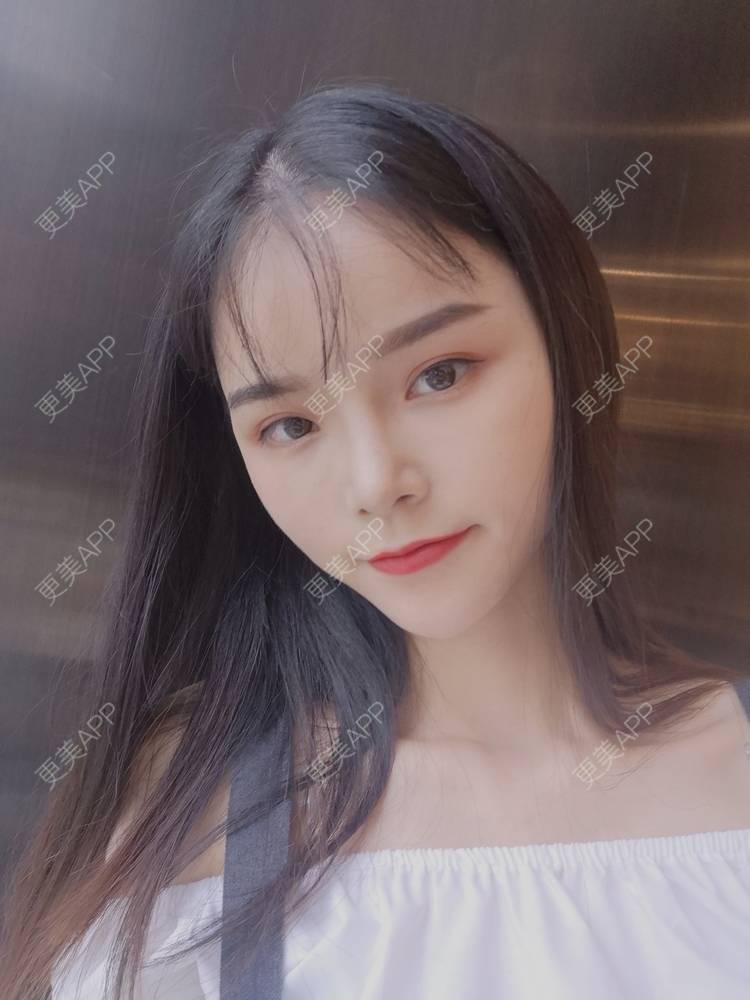 更美 - 莫宁🌸的自体脂肪填充泪沟经验 | 自体脂肪丰额头 | 自体脂肪填充泪沟 | 自体脂肪丰苹果肌 | 自体脂肪丰面颊 | 自体脂肪垫下巴 | 自体脂肪丰太阳穴 | 广州 | 视频日记