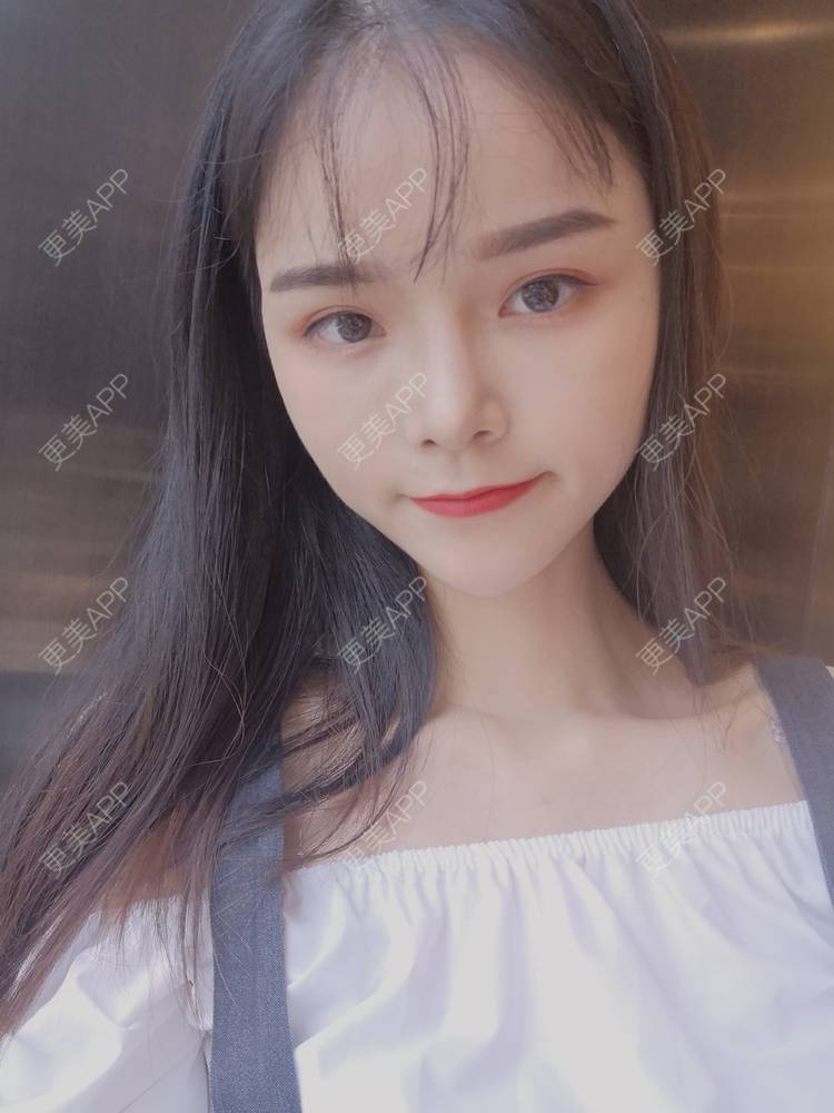 更美 - 莫宁🌸的自体脂肪填充泪沟经验 | 自体脂肪丰额头 | 自体脂肪填充泪沟 | 自体脂肪丰苹果肌 | 自体脂肪丰面颊 | 自体脂肪垫下巴 | 自体脂肪丰太阳穴 | 广州 | 视频日记