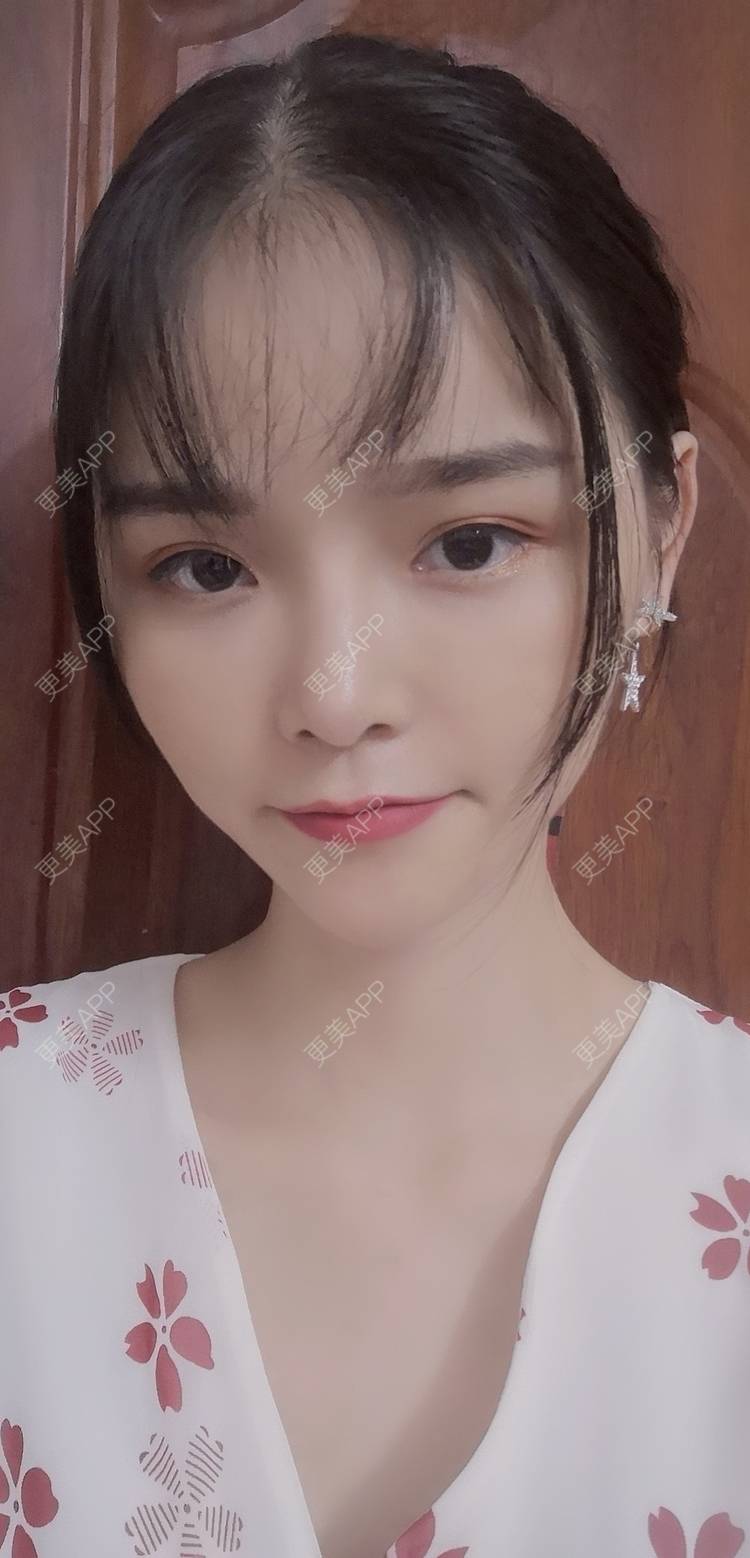 更美 - 莫宁🌸的自体脂肪填充泪沟经验 | 自体脂肪丰额头 | 自体脂肪填充泪沟 | 自体脂肪丰苹果肌 | 自体脂肪丰面颊 | 自体脂肪垫下巴 | 自体脂肪丰太阳穴 | 广州 | 视频日记