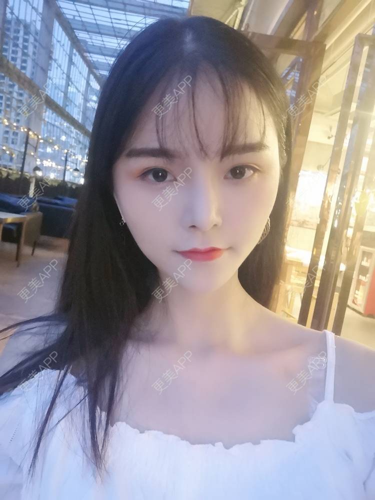 更美 - 莫宁🌸的自体脂肪填充泪沟经验 | 自体脂肪丰额头 | 自体脂肪填充泪沟 | 自体脂肪丰苹果肌 | 自体脂肪丰面颊 | 自体脂肪垫下巴 | 自体脂肪丰太阳穴 | 广州 | 视频日记