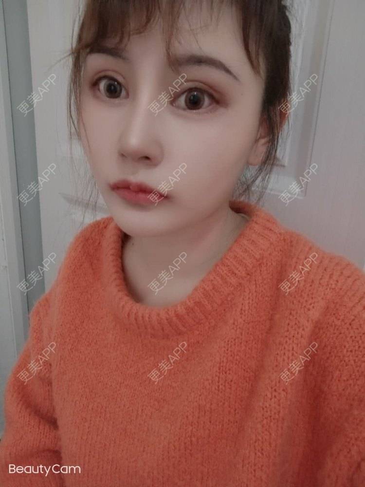 更美 - 更美用户U6Pt7ApV7A的吸脂瘦脸经验 | 吸脂瘦脸 | 重庆