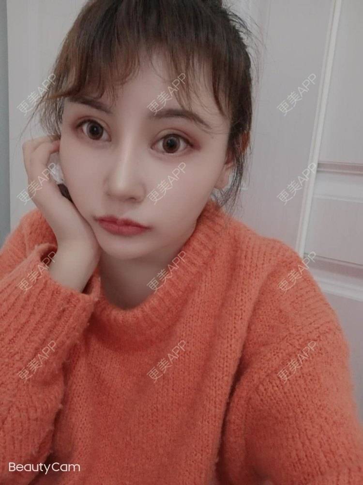 更美 - 更美用户U6Pt7ApV7A的吸脂瘦脸经验 | 吸脂瘦脸 | 重庆