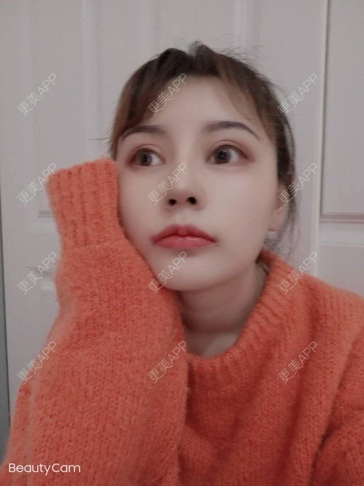 更美 - 更美用户U6Pt7ApV7A的吸脂瘦脸经验 | 吸脂瘦脸 | 重庆