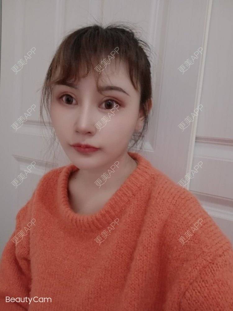 更美 - 更美用户U6Pt7ApV7A的吸脂瘦脸经验 | 吸脂瘦脸 | 重庆