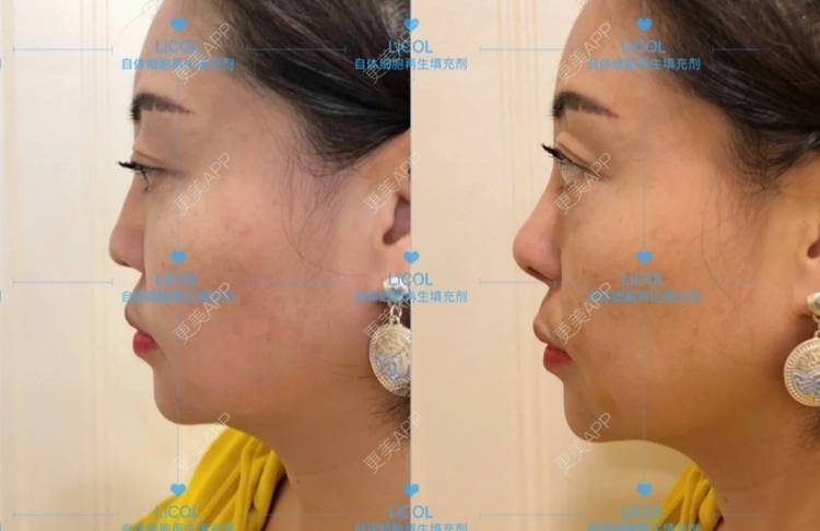 更美 - kioki33的鼻部多项经验 | 驼峰鼻矫正 | 歪鼻矫正 | 鼻部多项 | 西安
