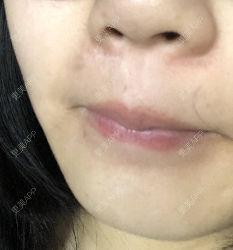 更美 - 更美用户D7fDWf5pP6的激光淡疤经验 | 上海 | 激光淡疤
