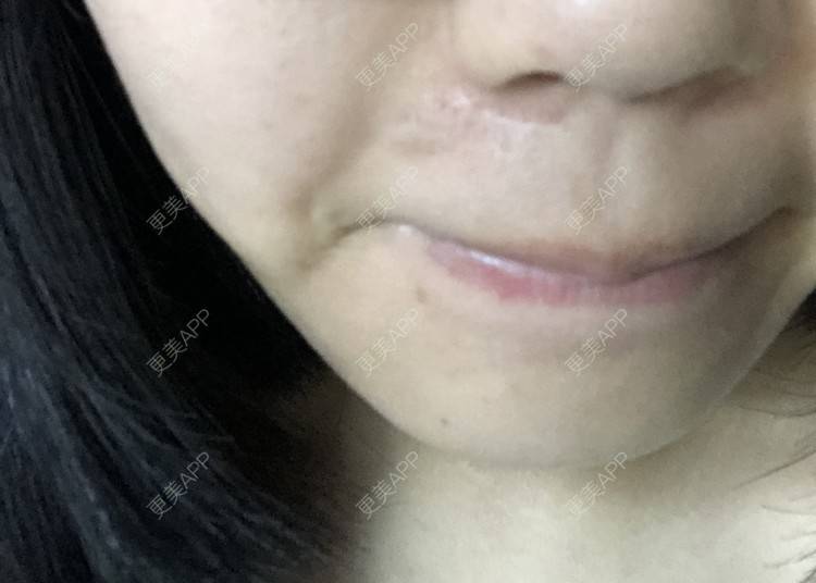 更美 - 更美用户D7fDWf5pP6的激光淡疤经验 | 上海 | 激光淡疤