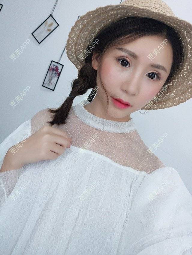 更美 - Imiss you的宽下巴矫正经验 | 玻尿酸下巴 | 下巴截骨前移 | 自体脂肪垫下巴 | 硅胶垫下巴 | 膨体垫下巴 | 宽下巴矫正 | 自体脂肪丰太阳穴 | 硅胶丰太阳穴 | 膨体丰太阳穴 | 人工骨垫下巴 | 成都