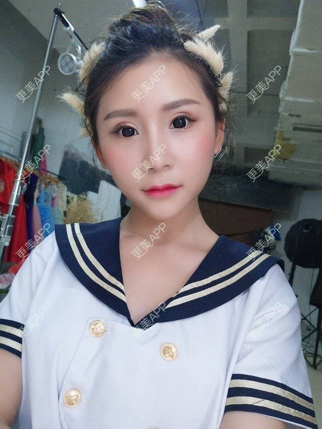更美 - Imiss you的宽下巴矫正经验 | 玻尿酸下巴 | 下巴截骨前移 | 自体脂肪垫下巴 | 硅胶垫下巴 | 膨体垫下巴 | 宽下巴矫正 | 自体脂肪丰太阳穴 | 硅胶丰太阳穴 | 膨体丰太阳穴 | 人工骨垫下巴 | 成都