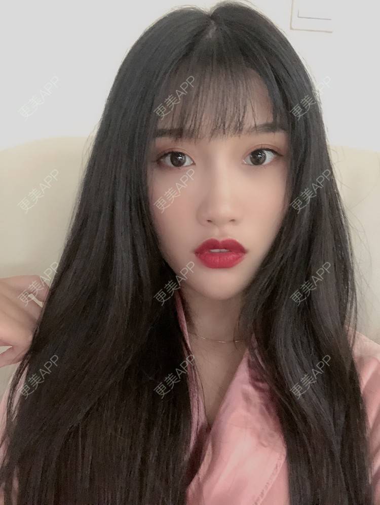 更美 - 木子木可的M唇成形经验 | M唇成形 | 杭州