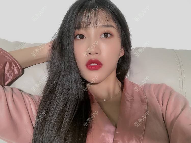 更美 - 木子木可的M唇成形经验 | M唇成形 | 杭州