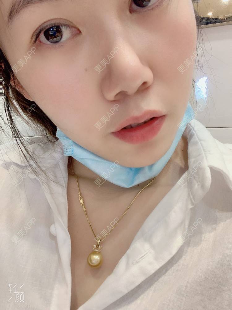 更美 - 浃浃！的厚唇改薄经验 | 厚唇改薄 | 上海