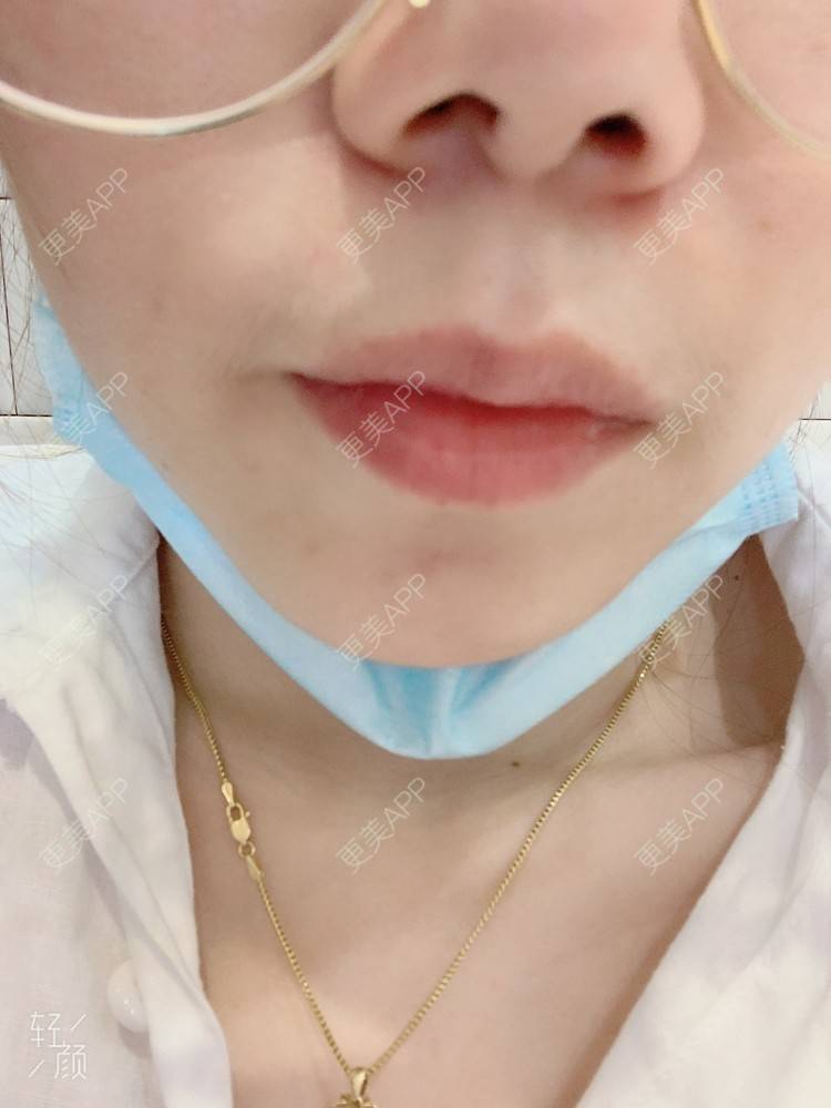 更美 - 浃浃！的厚唇改薄经验 | 厚唇改薄 | 上海