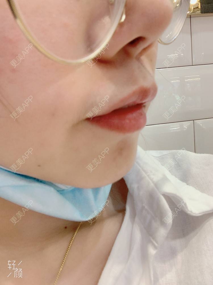 更美 - 浃浃！的厚唇改薄经验 | 厚唇改薄 | 上海