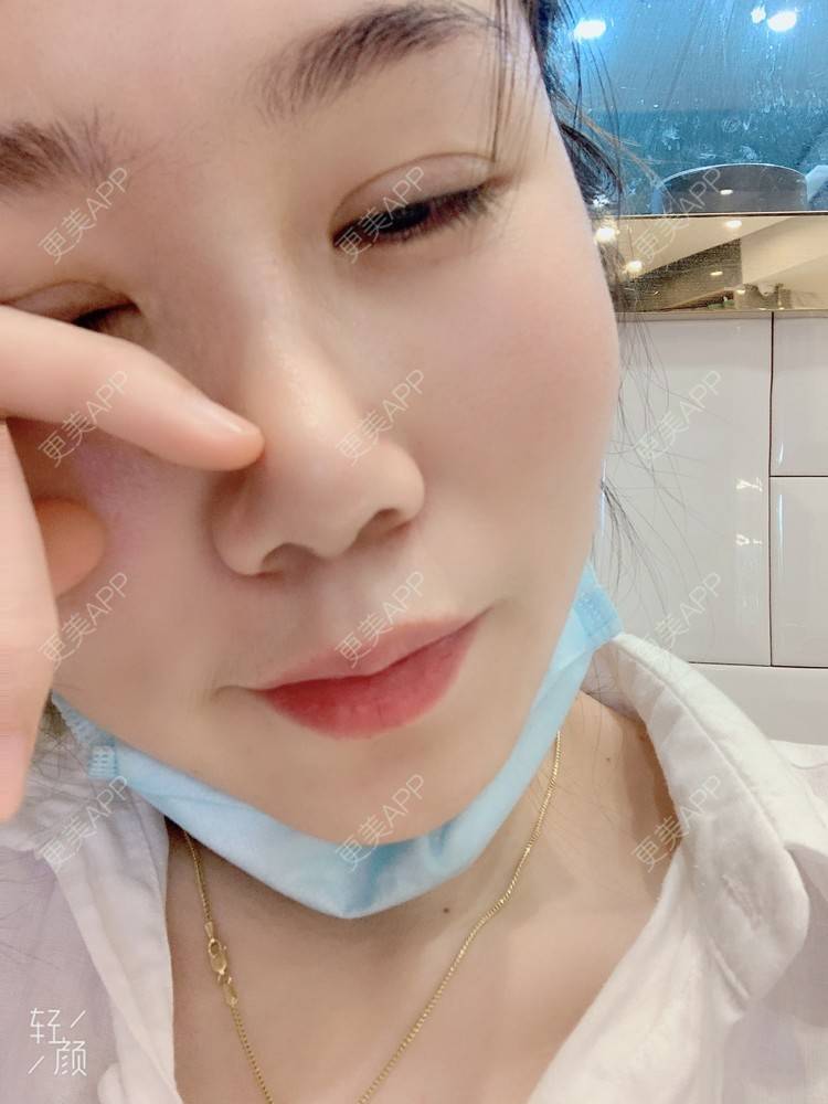 更美 - 浃浃！的厚唇改薄经验 | 厚唇改薄 | 上海