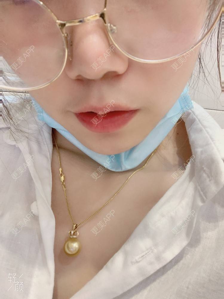 更美 - 浃浃！的厚唇改薄经验 | 厚唇改薄 | 上海