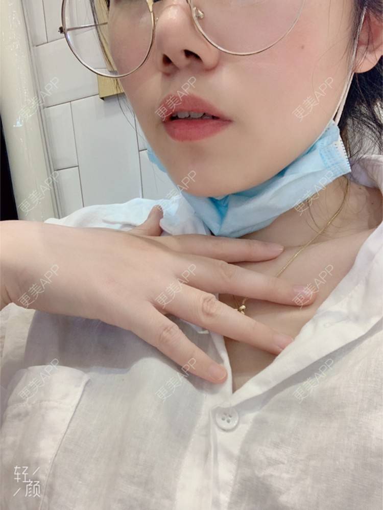 更美 - 浃浃！的厚唇改薄经验 | 厚唇改薄 | 上海