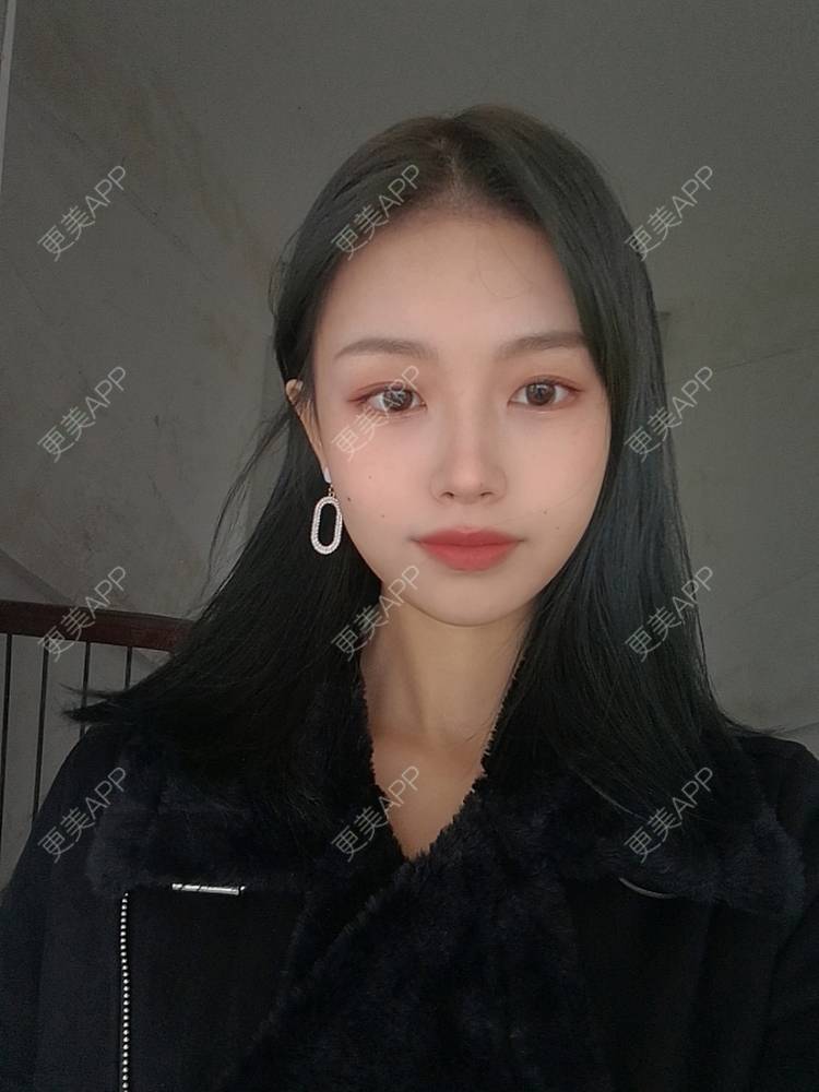 更美 - 不要奶茶的M唇成形经验 | M唇成形 | 杭州