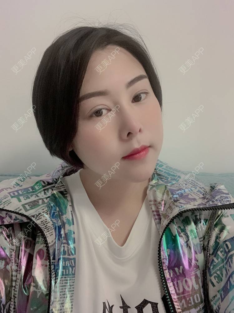 更美 - 芳芳曹的肋软骨隆鼻经验 | 视频日记 | 杭州 | 肋软骨隆鼻 | 隆鼻 | 更美研究所