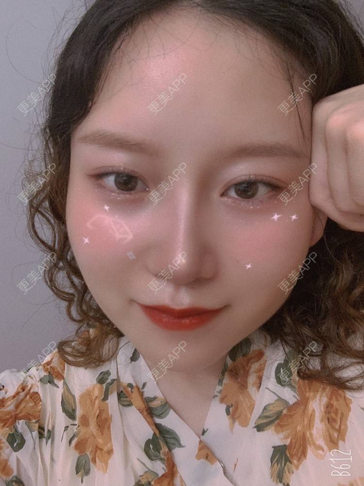 更美 - 圆方脸课代表ʚ😊ɞ的隆鼻经验 | 耳软骨隆鼻 | 假体垫鼻基底 | 鼻部多项 | 隆鼻 | 全切双眼皮 | 自体软骨垫鼻尖 | 硅胶隆鼻 | 南京 | 视频日记