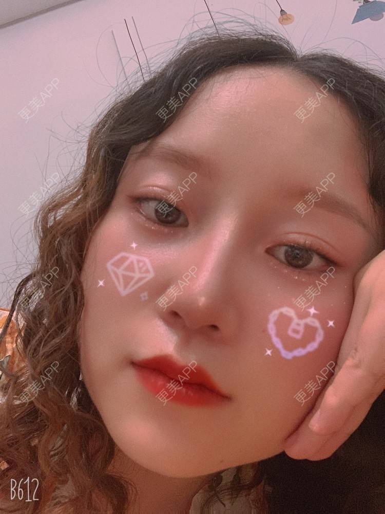 更美 - 圆方脸课代表ʚ😊ɞ的隆鼻经验 | 耳软骨隆鼻 | 假体垫鼻基底 | 鼻部多项 | 隆鼻 | 全切双眼皮 | 自体软骨垫鼻尖 | 硅胶隆鼻 | 南京 | 视频日记