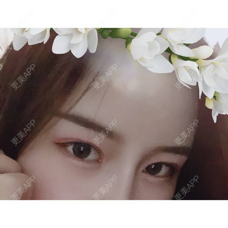 更美 - 圆方脸课代表ʚ😊ɞ的隆鼻经验 | 耳软骨隆鼻 | 假体垫鼻基底 | 鼻部多项 | 隆鼻 | 全切双眼皮 | 自体软骨垫鼻尖 | 硅胶隆鼻 | 南京 | 视频日记
