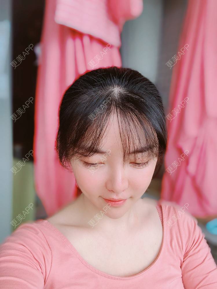 更美 - 向阳葵21的植发际线经验 | 植眉 | 植发际线 | 广州