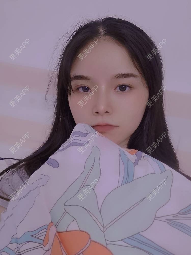 更美 - 莫宁🌸的自体脂肪填充泪沟经验 | 自体脂肪填充泪沟 | 自体脂肪丰太阳穴 | 自体脂肪丰苹果肌 | 自体脂肪丰面颊 | 自体脂肪垫下巴 | 自体脂肪丰额头 | 广州