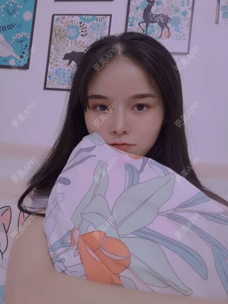 更美 - 莫宁🌸的自体脂肪填充泪沟经验 | 自体脂肪填充泪沟 | 自体脂肪丰太阳穴 | 自体脂肪丰苹果肌 | 自体脂肪丰面颊 | 自体脂肪垫下巴 | 自体脂肪丰额头 | 广州