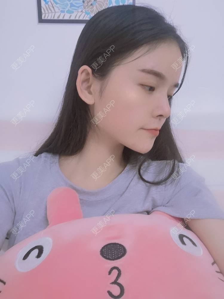 更美 - 莫宁🌸的自体脂肪填充泪沟经验 | 自体脂肪填充泪沟 | 自体脂肪丰太阳穴 | 自体脂肪丰苹果肌 | 自体脂肪丰面颊 | 自体脂肪垫下巴 | 自体脂肪丰额头 | 广州