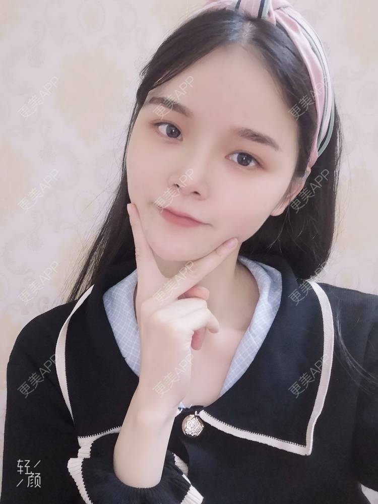 更美 - 莫宁🌸的自体脂肪填充泪沟经验 | 自体脂肪填充泪沟 | 自体脂肪丰太阳穴 | 自体脂肪丰苹果肌 | 自体脂肪丰面颊 | 自体脂肪垫下巴 | 自体脂肪丰额头 | 广州