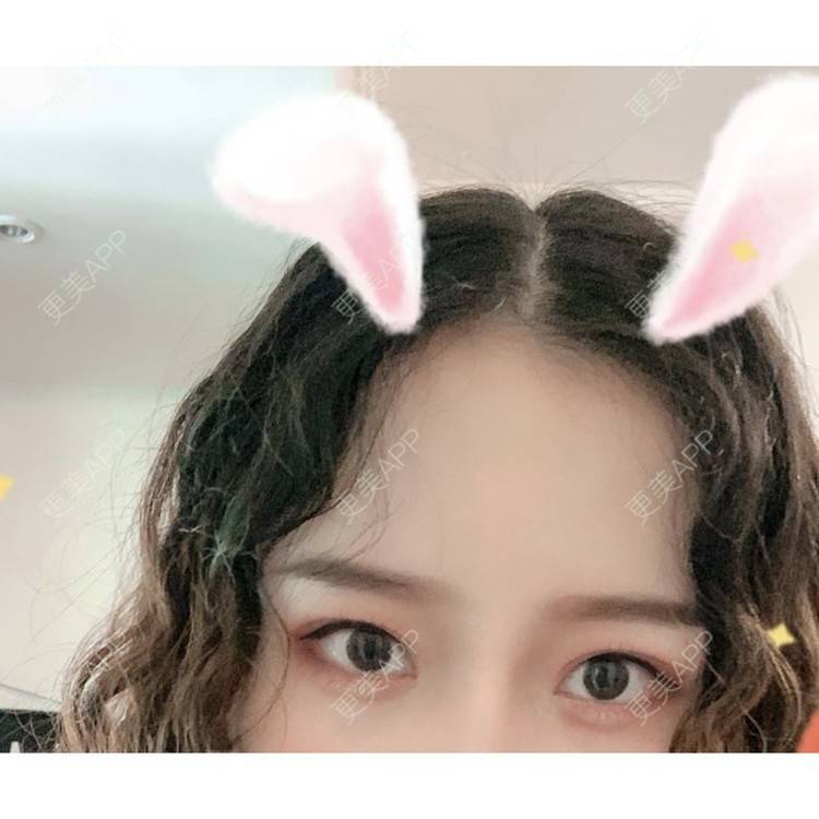 更美 - 圆方脸课代表ʚ😊ɞ的隆鼻经验 | 硅胶隆鼻 | 假体垫鼻基底 | 鼻部多项 | 自体软骨垫鼻尖 | 隆鼻 | 全切双眼皮 | 南京 | 耳软骨隆鼻 | 视频日记