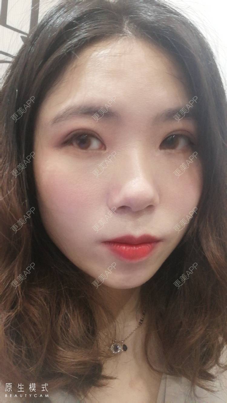 更美 - 墨七轩的双眼皮经验 | 双眼皮 | 全切双眼皮 | 开内眼角 | 开外眼角 | 杭州