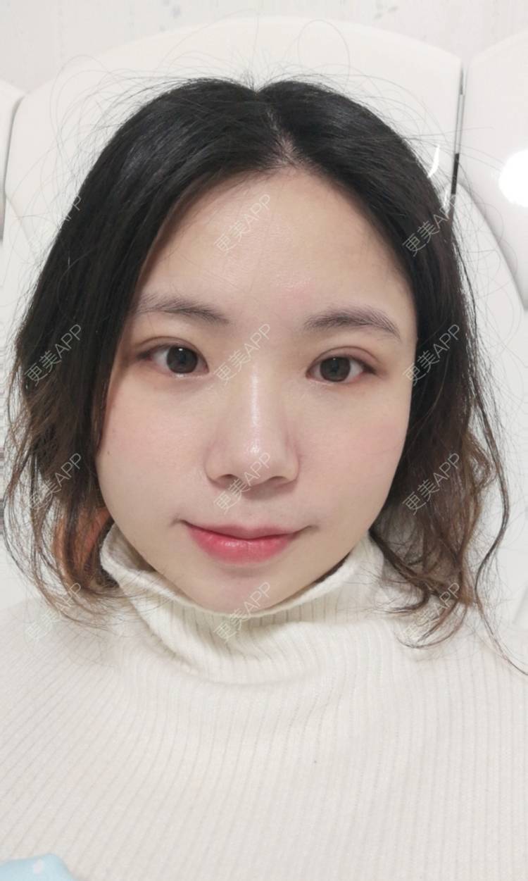 更美 - 墨七轩的双眼皮经验 | 双眼皮 | 全切双眼皮 | 开内眼角 | 开外眼角 | 杭州